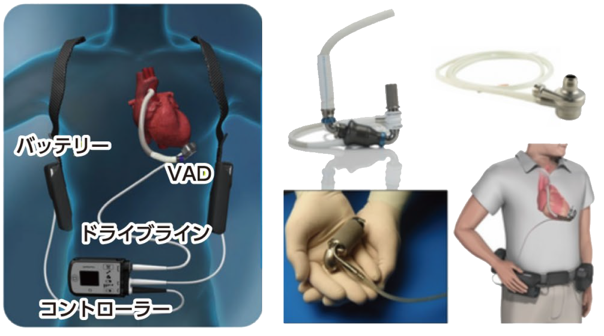 VADの説明図