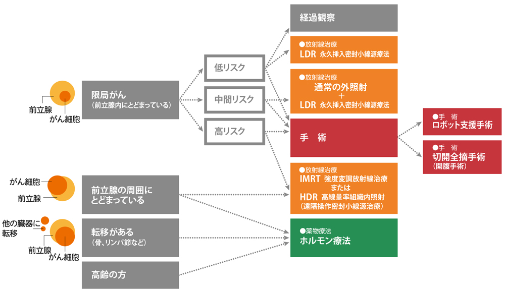 前立腺がんの状態と治療法の選択