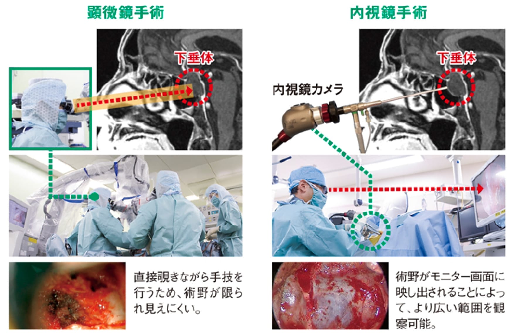 下垂体手術の方法