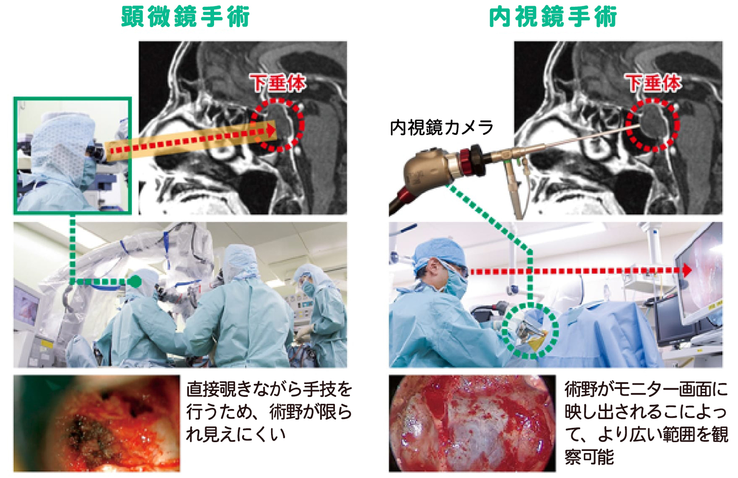 下垂体腫瘍の手術方法