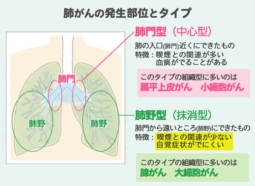 肺がんの発生部位とタイプ