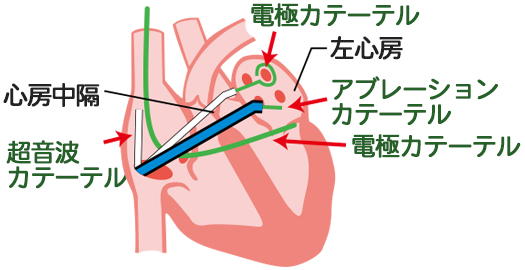 心臓内のカテーテルの経路