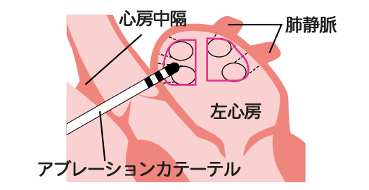 焼灼の場所