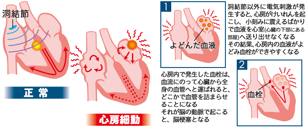 心房細動の仕組み