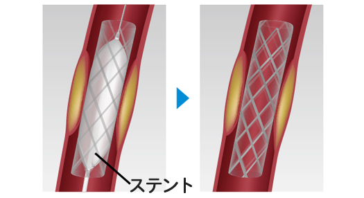 ステント