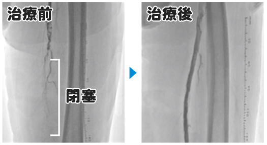 血管の拡張の様子