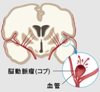 脳動脈瘤の図