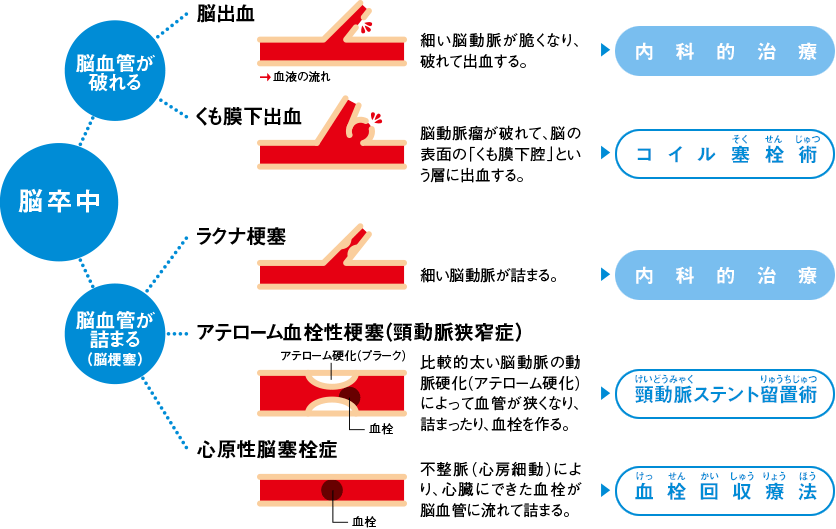 脳卒中の治療選択肢