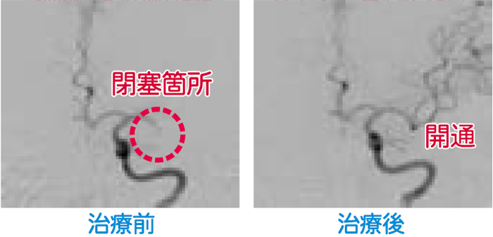 治療前と治療後の血流の写真
