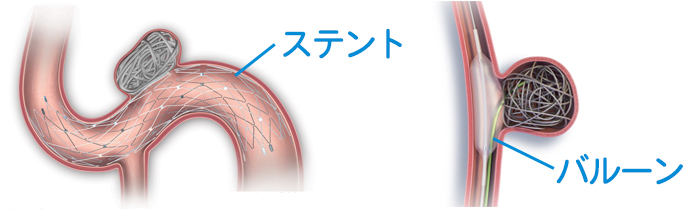ステント、バルーン