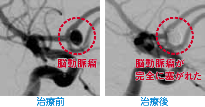 治療前と治療後の造影写真