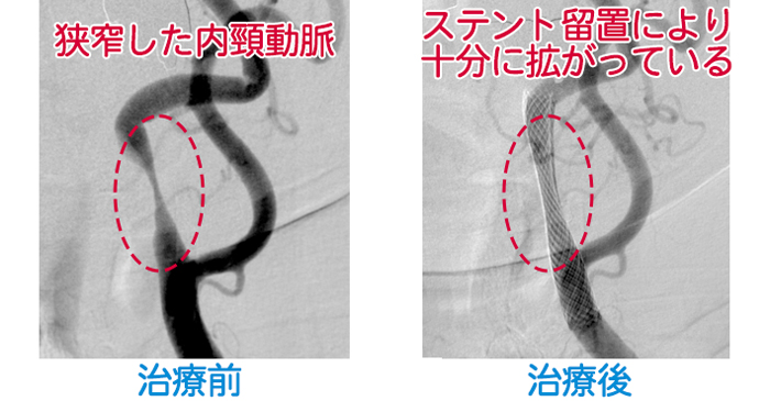 治療前と治療後の血管の写真