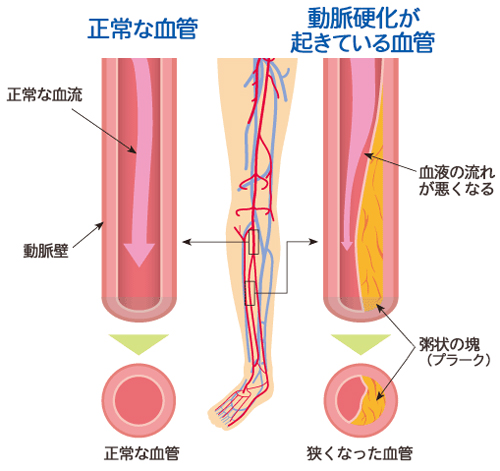 閉塞性動脈硬化症のイメージ