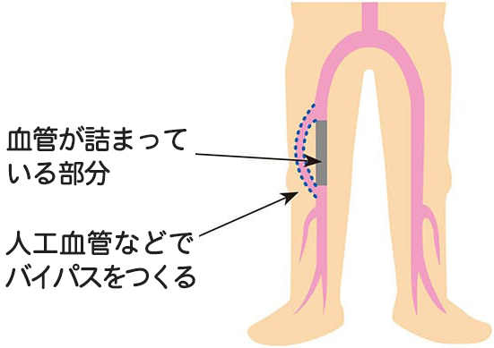 バイパス術