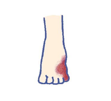 潰瘍・壊死