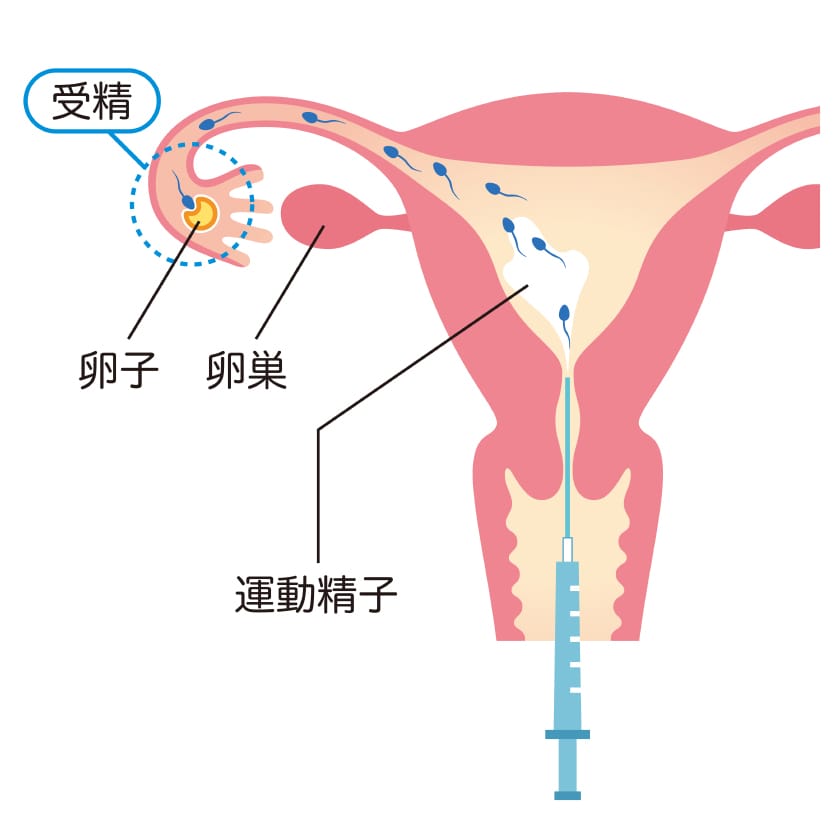人工授精の図