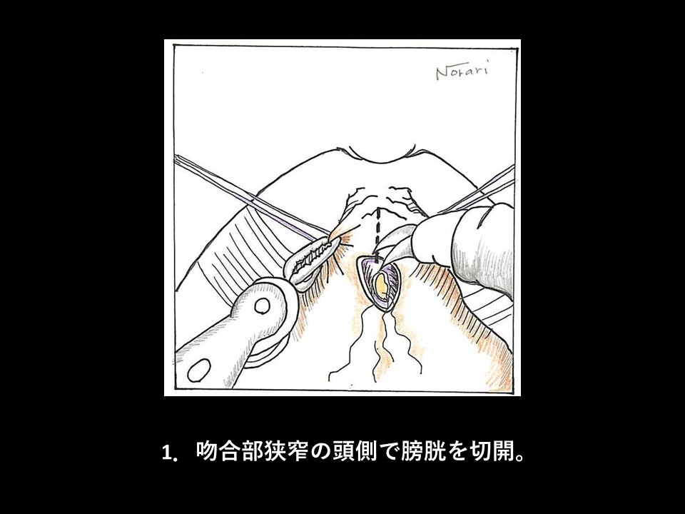 ロボット支援下経括約筋的後部尿道形成術の流れ02