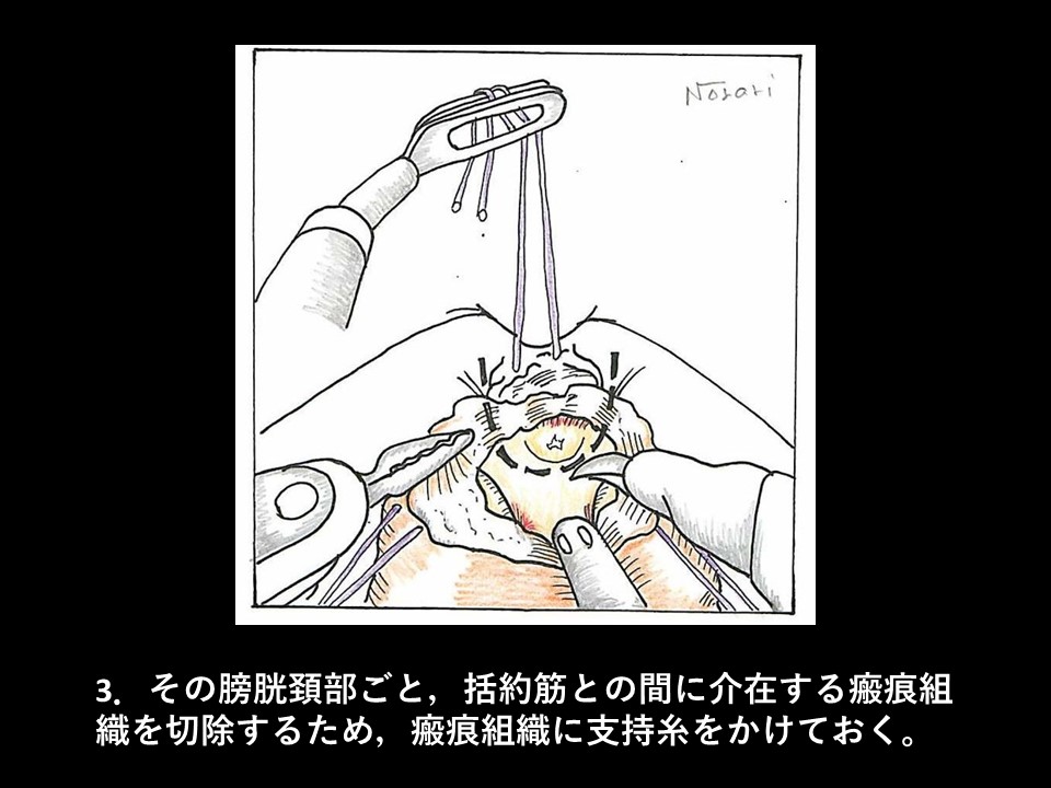 ロボット支援下経括約筋的後部尿道形成術の流れ04