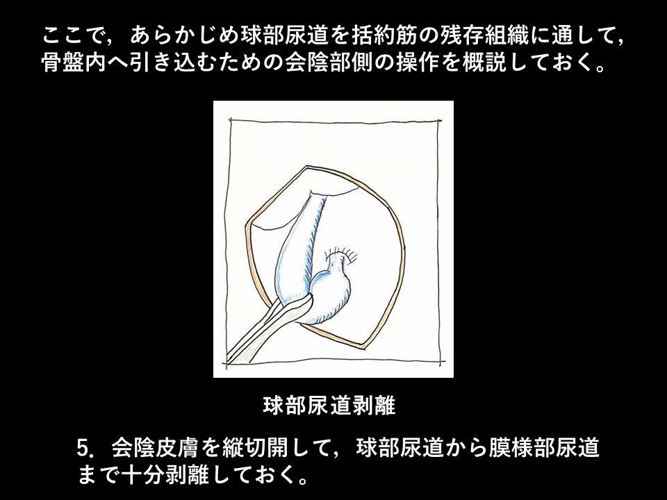 ロボット支援下経括約筋的後部尿道形成術の流れ07