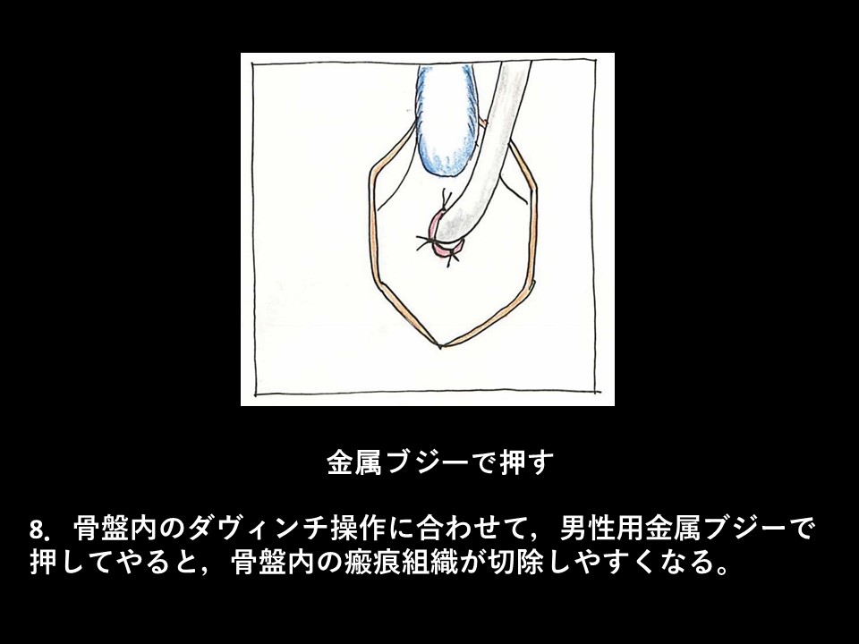 ロボット支援下経括約筋的後部尿道形成術の流れ10