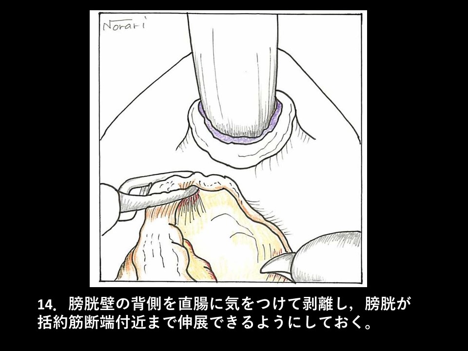 ロボット支援下経括約筋的後部尿道形成術の流れ16