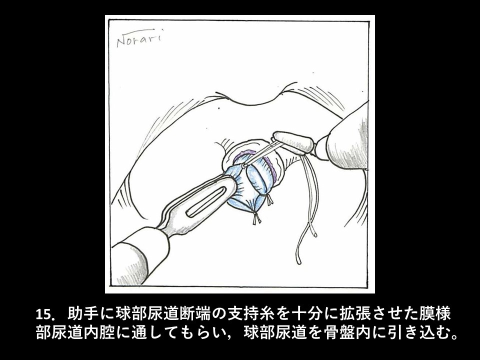 ロボット支援下経括約筋的後部尿道形成術の流れ17