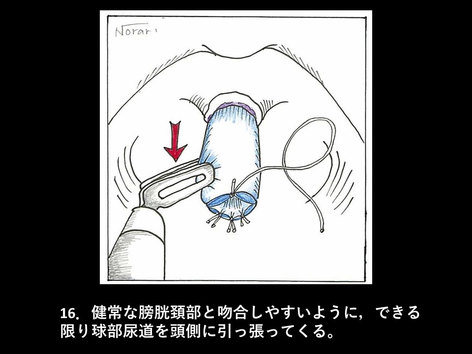 ロボット支援下経括約筋的後部尿道形成術の流れ18