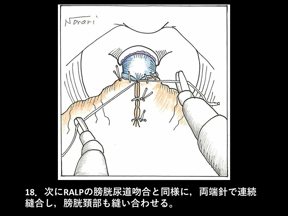 ロボット支援下経括約筋的後部尿道形成術の流れ20